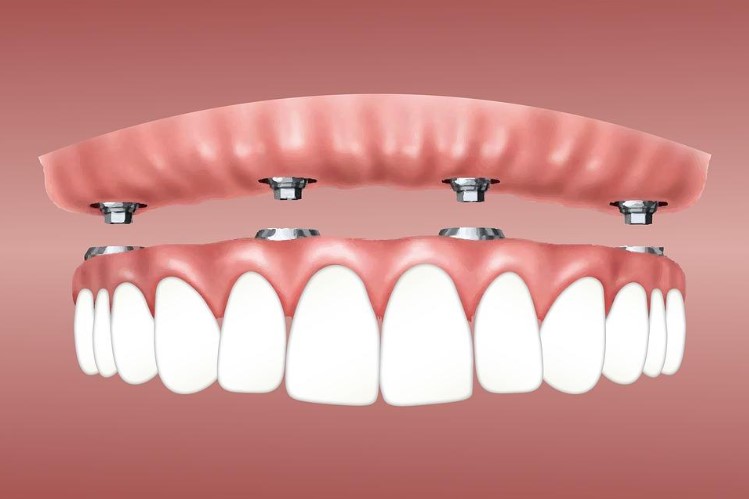 A Guide to Understanding Dental Implants and Its Costs