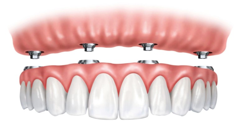 Dental Implants: Types and Costs Explained