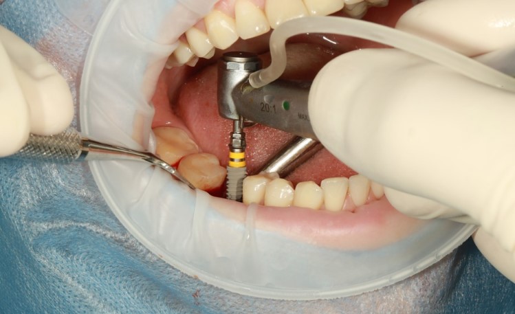 Dental Implants Procedure: What to Expect During and After Surgery
