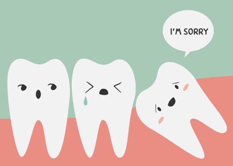 Wisdom Teeth Impaction: All You Need to Know