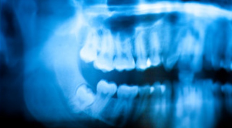 When Should I Remove My Wisdom Teeth? 6 Signs to Watch Out For